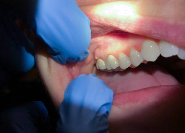 Best Emergency Tooth Extraction in Ponderosa Park, CO
