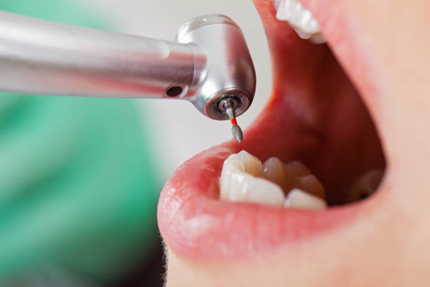 Best Emergency Tooth Extraction in Ponderosa Park, CO